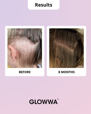 Before and after comparison of hair growth using Glowwa on a light purple background.